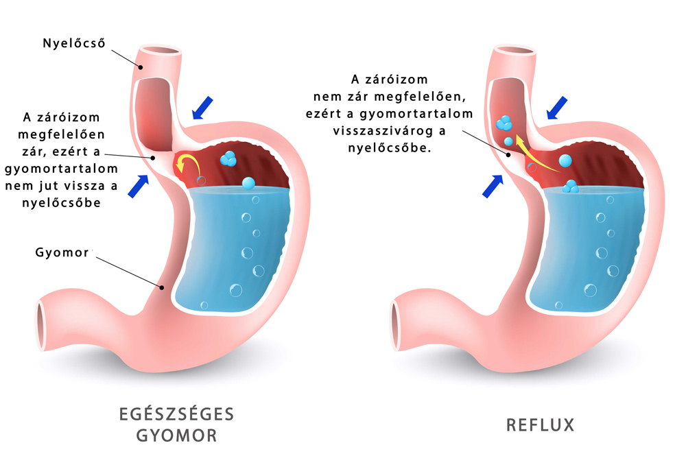 reflux súlycsökkenést okozhat